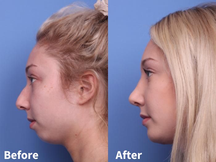 Before and after images of chin surgery